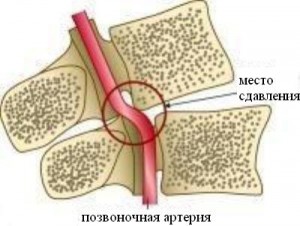 Причины появления и способы лечения шейного остеохондроза